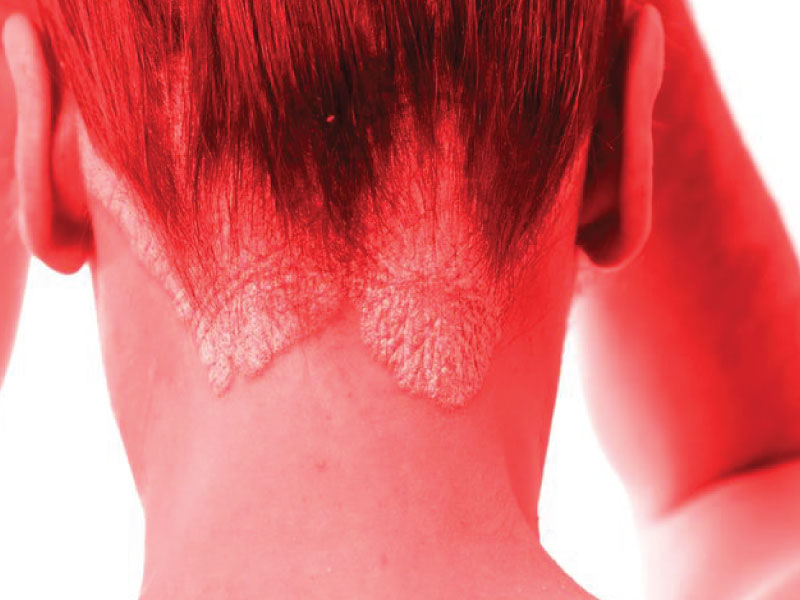 نوردرمانی برای بیماری پسوریازیس